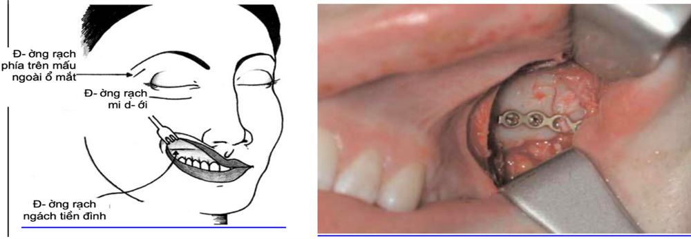 Đánh giá kết quả phẫu thuật gãy xương gò má cung tiếp bằng nẹp vít tại Bệnh viện Đa khoa Hải Dương